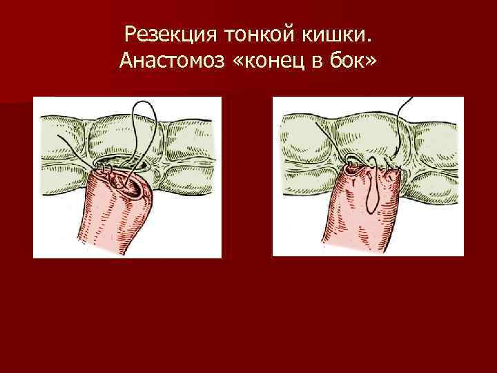 Резекция тонкой кишки. Анастомоз «конец в бок» 