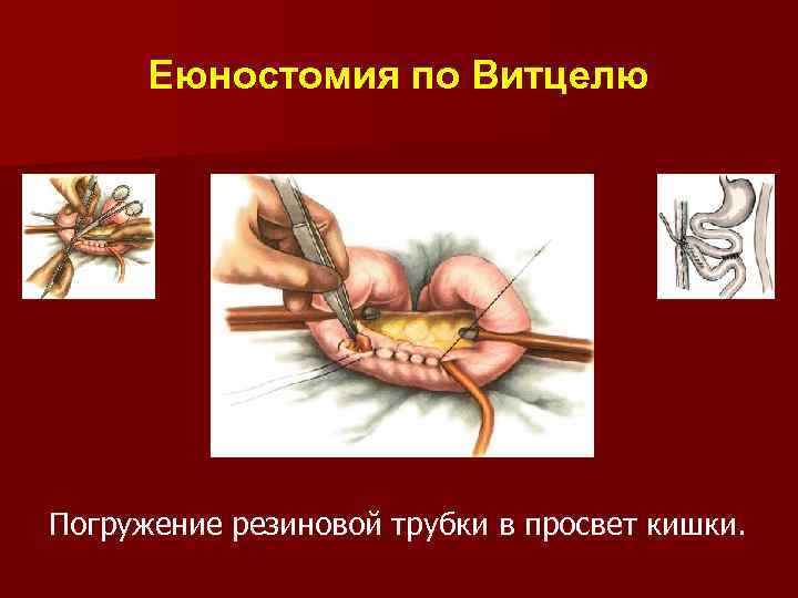 Еюностомия по Витцелю Погружение резиновой трубки в просвет кишки. 