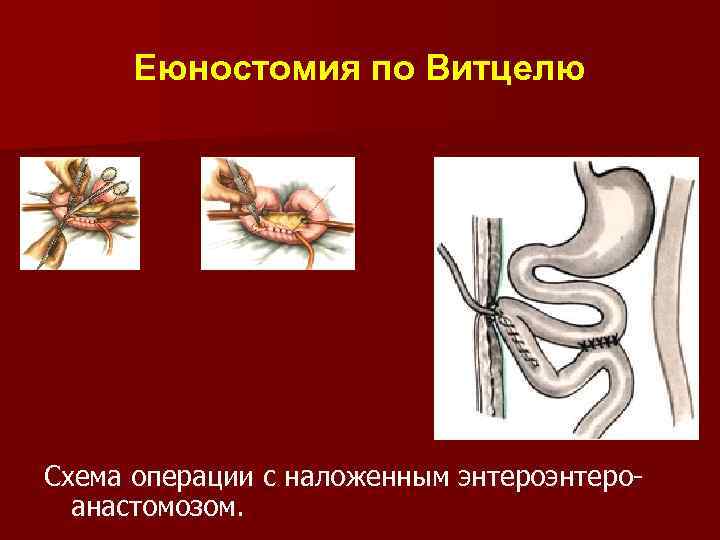 Еюностомия по Витцелю Схема операции с наложенным энтероанастомозом. 