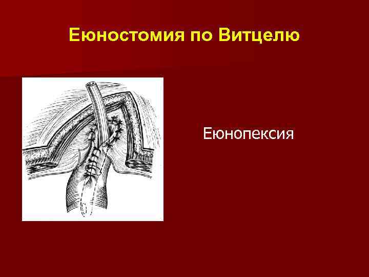 Еюностомия по Витцелю Еюнопексия 