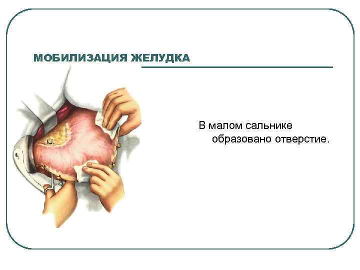 Метастазы в сальнике прогноз