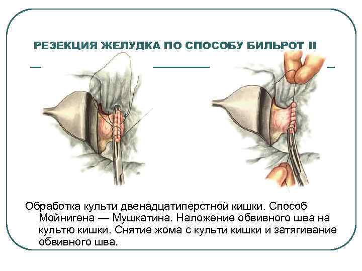 РЕЗЕКЦИЯ ЖЕЛУДКА ПО СПОСОБУ БИЛЬРОТ II Обработка культи двенадцатиперстной кишки. Способ Мойнигена — Мушкатина.