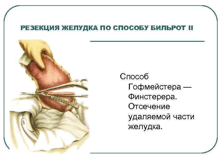 РЕЗЕКЦИЯ ЖЕЛУДКА ПО СПОСОБУ БИЛЬРОТ II Способ Гофмейстера — Финстерера. Отсечение удаляемой части желудка.