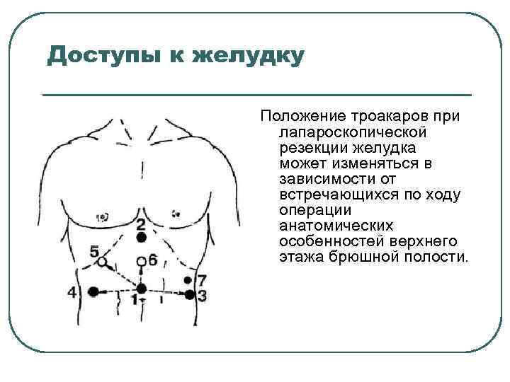 Положение желудка. Расположение троакаров при лапароскопической гастрэктомии. Точки введения троакаров при лапароскопической аппендэктомии. Лапароскопическая резекция желудка. Точки введения троакаров при лапароскопической операции.