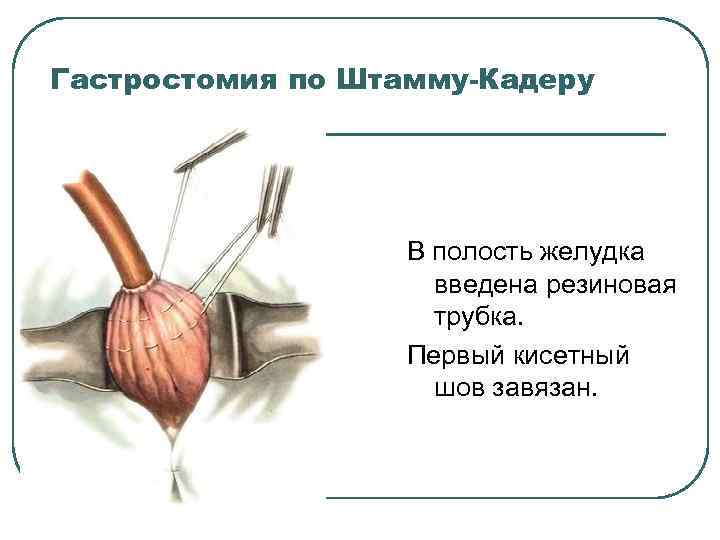 Гастростомия по Штамму-Кадеру В полость желудка введена резиновая трубка. Первый кисетный шов завязан. 