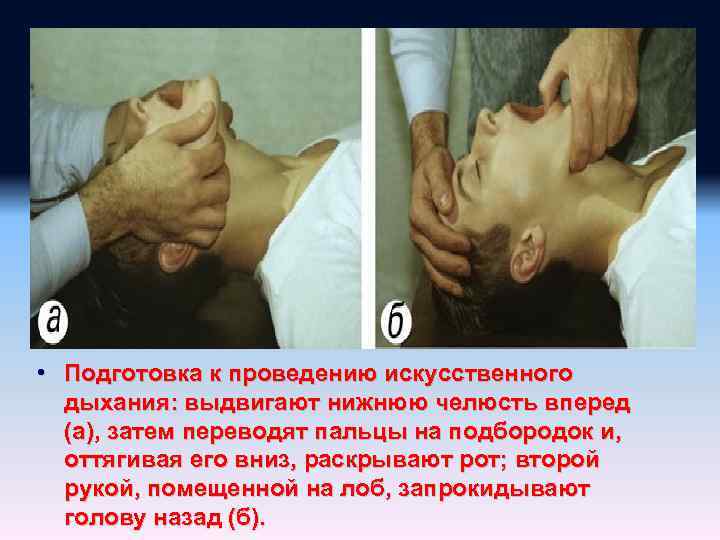  • Подготовка к проведению искусственного дыхания: выдвигают нижнюю челюсть вперед (а), затем переводят