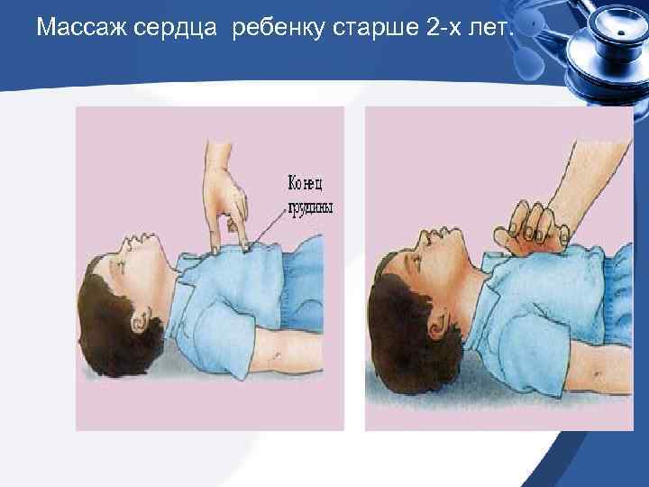Массаж сердца ребенку старше 2 -х лет. 