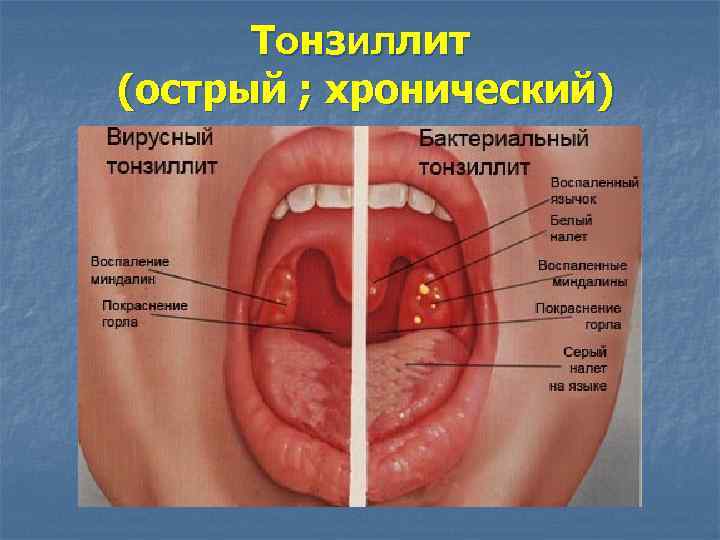 Тонзиллит (острый ; хронический) 