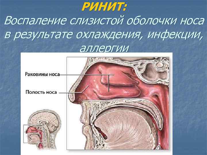 РИНИТ: Воспаление слизистой оболочки носа в результате охлаждения, инфекции, аллергии 