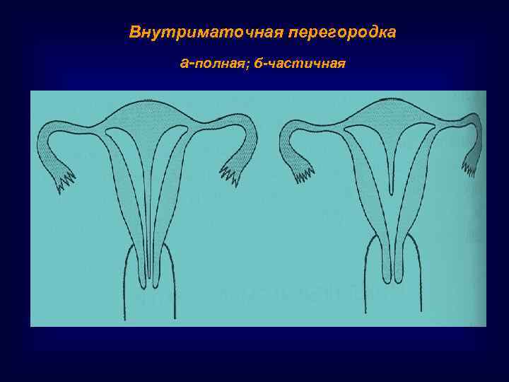 Внутриматочная перегородка а-полная; б-частичная 