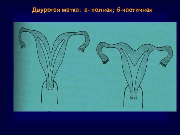 Двурогая матка: а- полная; б-частичная 