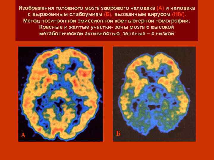 Изображения головного мозга здорового человека (А) и человека с выраженным слабоумием (Б), вызванным вирусом
