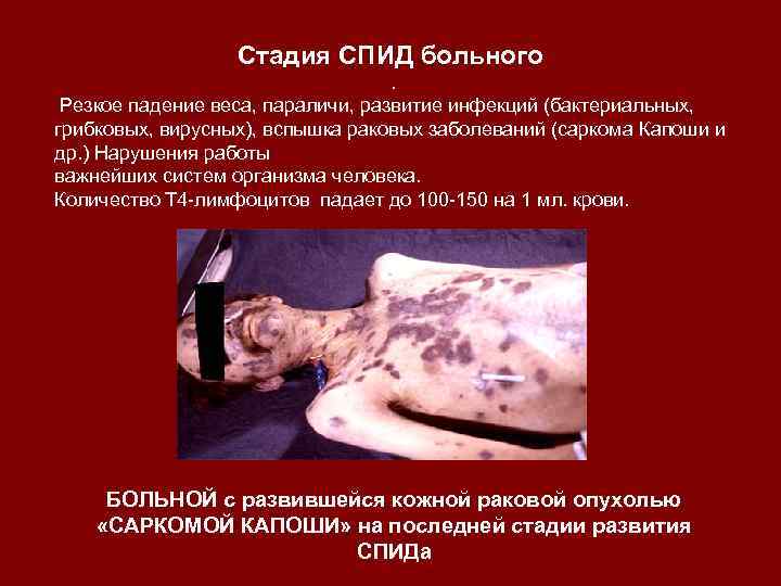 Стадия СПИД больного. Резкое падение веса, параличи, развитие инфекций (бактериальных, грибковых, вирусных), вспышка раковых
