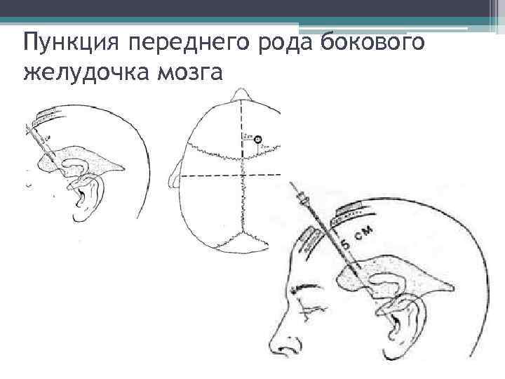 Пункция мозга. Пункция переднего и заднего рога бокового желудочка. Пункция переднего рога бокового желудочка мозга. Пункция бокового желудочка в точке кохера. Пункция желудочков мозга техника.