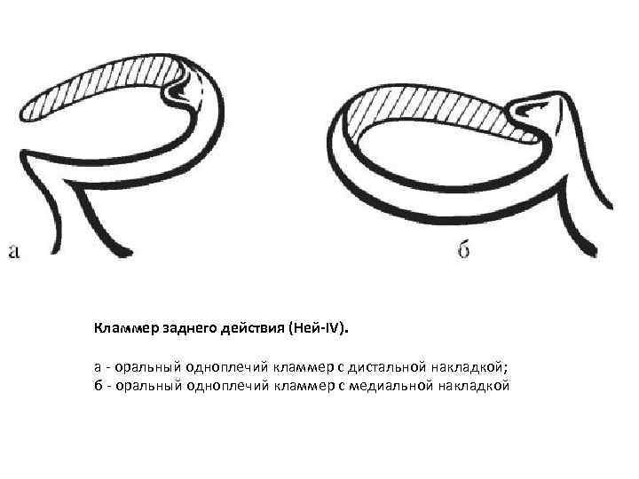 Кламмерная линия на нижней челюсти