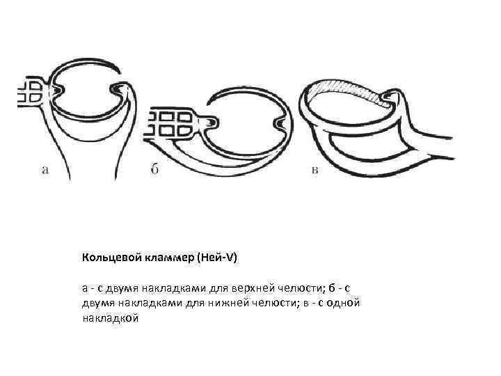 Кольцевой кламмер (Ней-V) а - с двумя накладками для верхней челюсти; б - с