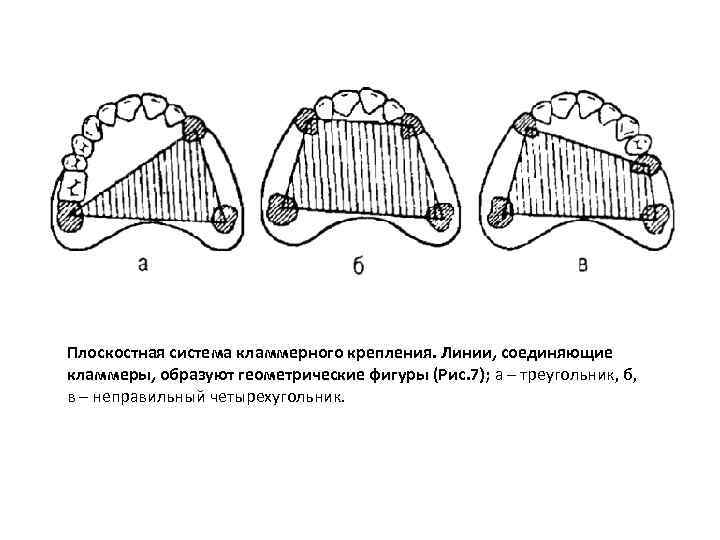 Кламмерная линия на нижней челюсти