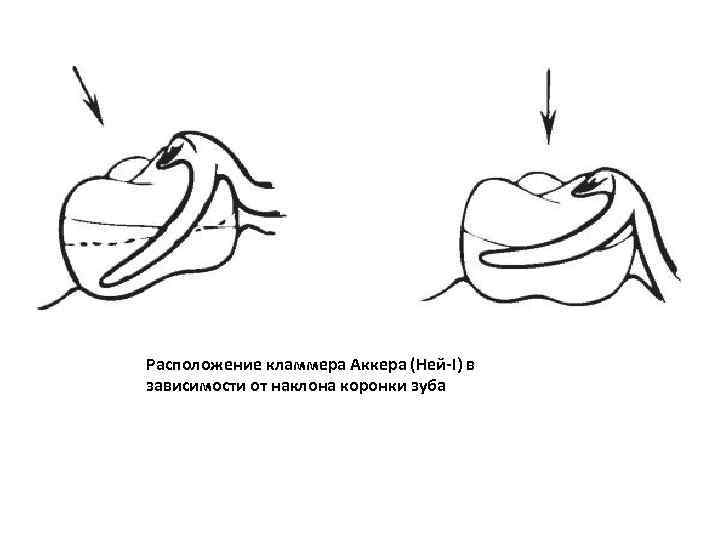 Расположение кламмера Аккера (Ней-I) в зависимости от наклона коронки зуба 