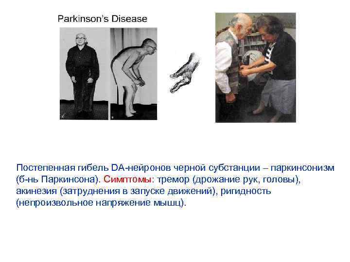Постепенная гибель DA-нейронов черной субстанции – паркинсонизм (б-нь Паркинсона). Симптомы: тремор (дрожание рук, головы),