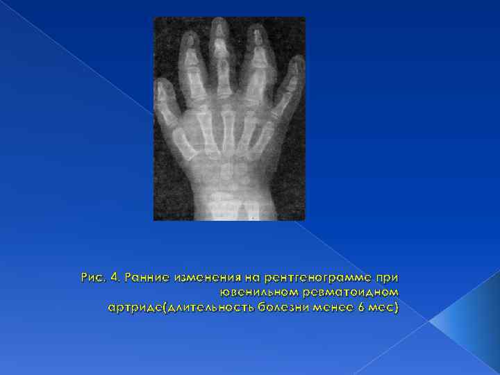 Рис. 4. Ранние изменения на рентгенограмме при ювенильном ревматоидном артриде(длительность болезни менее 6 мес)