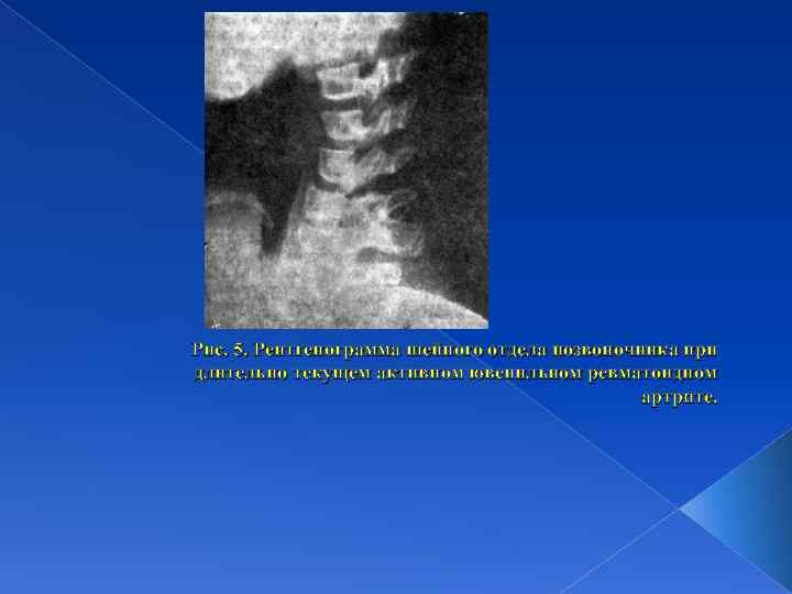 Рис. 5. Рентгенограмма шейного отдела позвоночника при длительно текущем активном ювенильном ревматоидном артрите. 