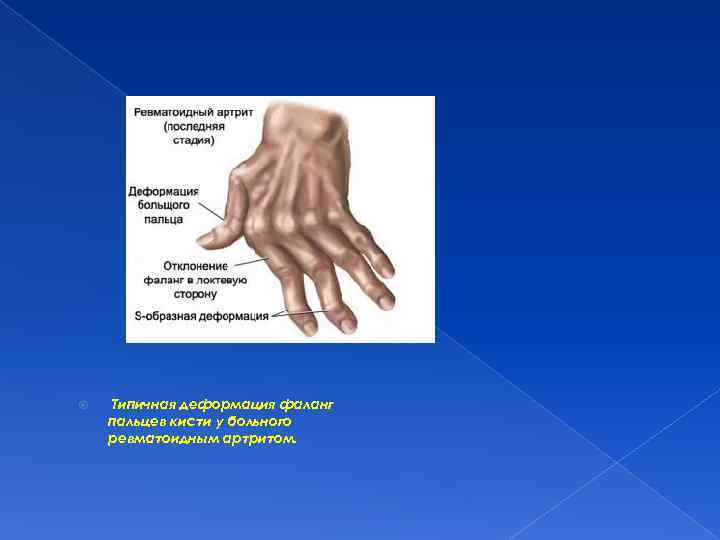  Типичная деформация фаланг пальцев кисти у больного ревматоидным артритом. 