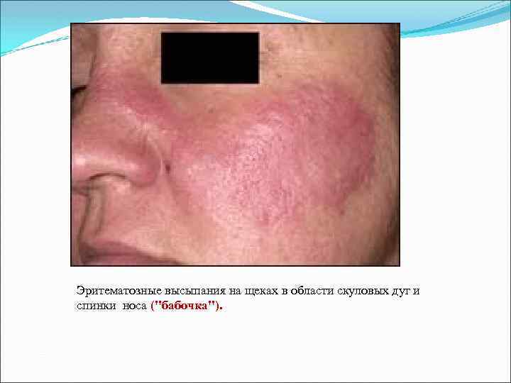 Эритематозные высыпания на щеках в области скуловых дуг и спинки носа (