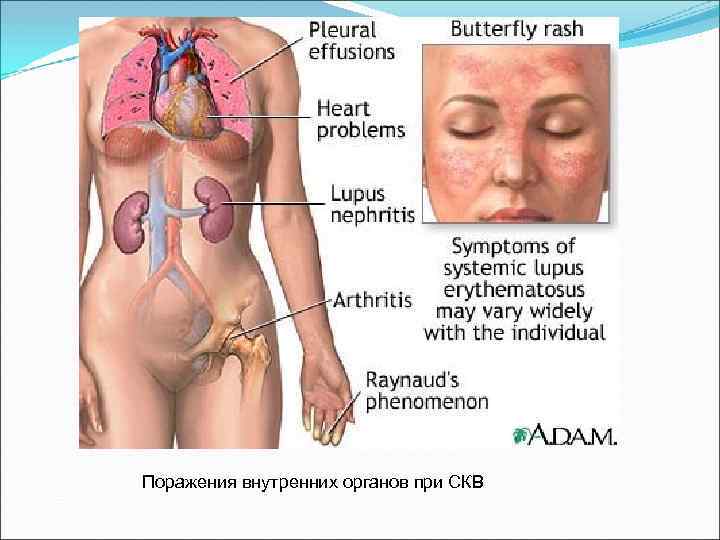 Поражения внутренних органов при СКВ 