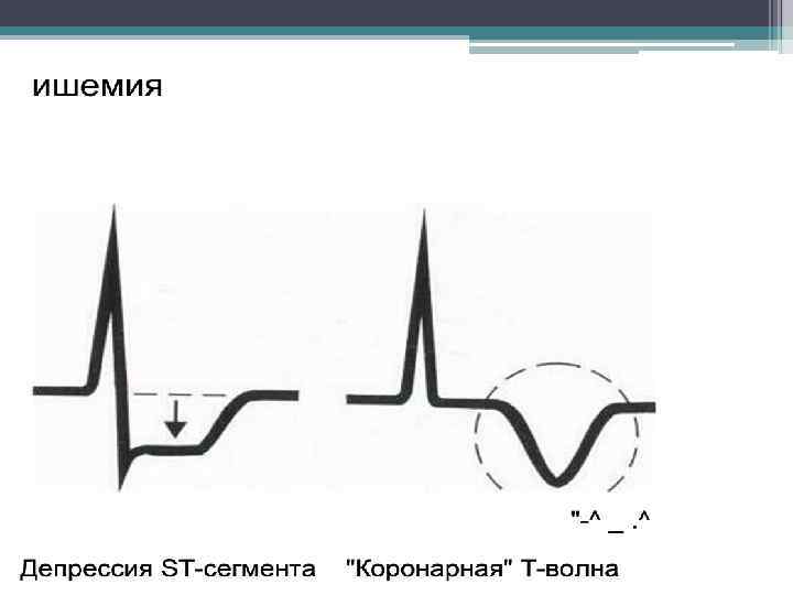 Депрессия сегмента st