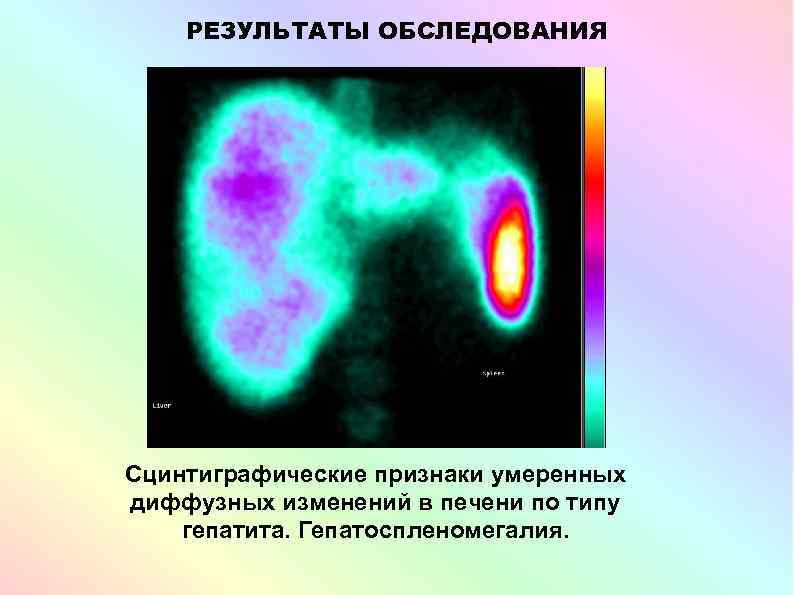 РЕЗУЛЬТАТЫ ОБСЛЕДОВАНИЯ Сцинтиграфические признаки умеренных диффузных изменений в печени по типу гепатита. Гепатоспленомегалия. 