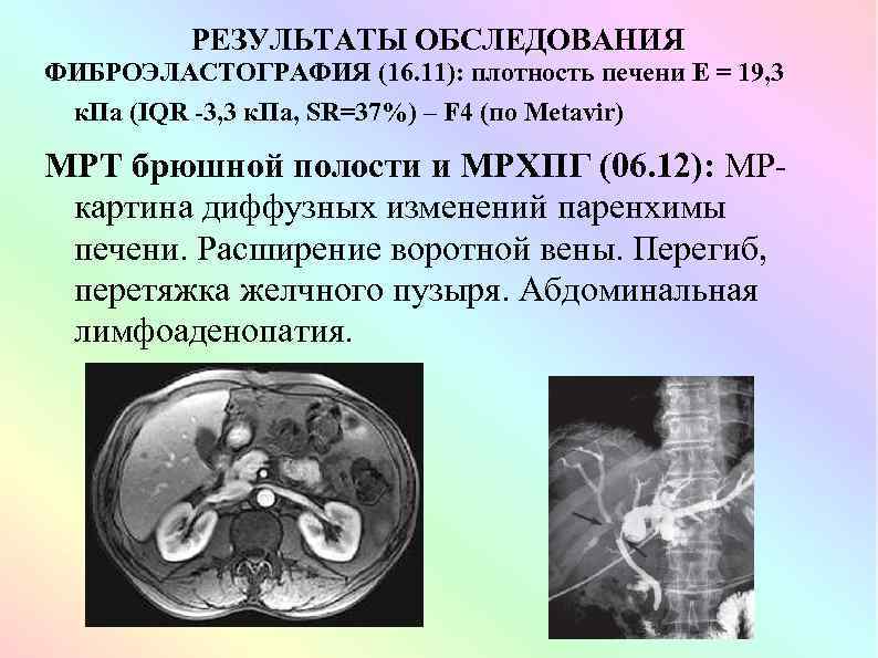 РЕЗУЛЬТАТЫ ОБСЛЕДОВАНИЯ ФИБРОЭЛАСТОГРАФИЯ (16. 11): плотность печени Е = 19, 3 к. Па (IQR