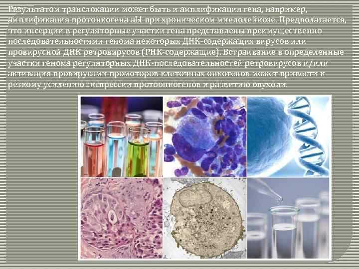 Результатом транслокации может быть и амплификация гена, например, амплификация протонкогена а. Ы при хроническом