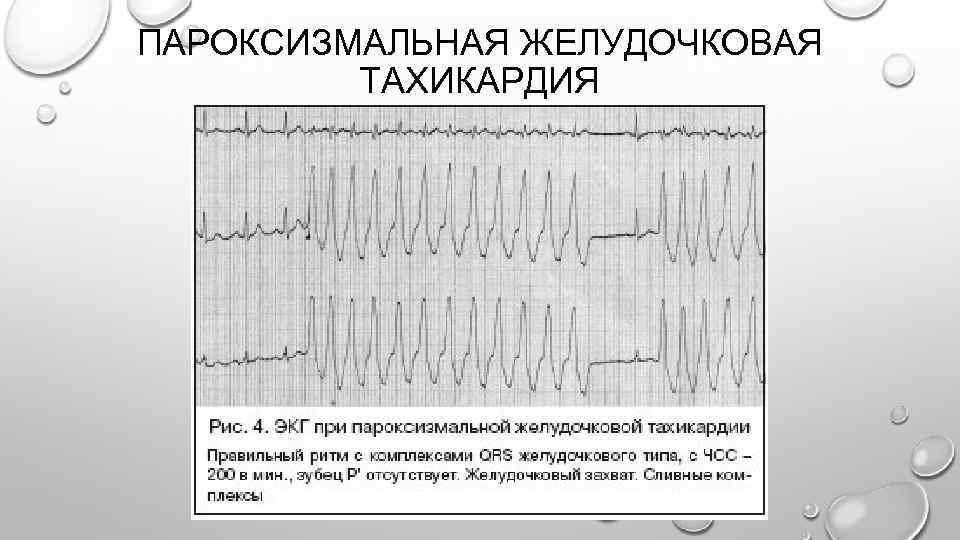 Пароксизмальная тахикардия карта смп