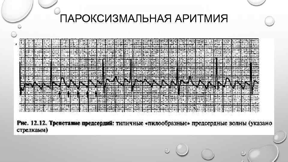 ПАРОКСИЗМАЛЬНАЯ АРИТМИЯ 