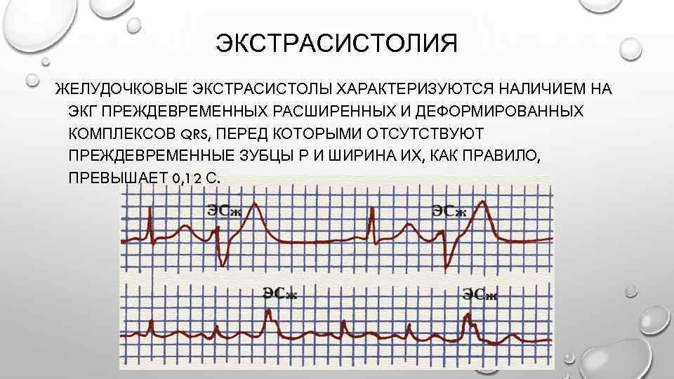 Экстрасистолы во время