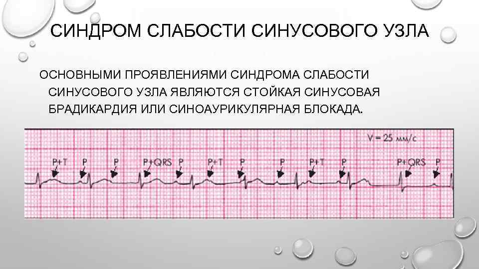 Сссу в кардиологии. Синдром слабости синоатриального узла ЭКГ. Синдром слабости синусового узла ЭКГ. Слабость синусового узла на ЭКГ. Синдром синусового узла на ЭКГ.