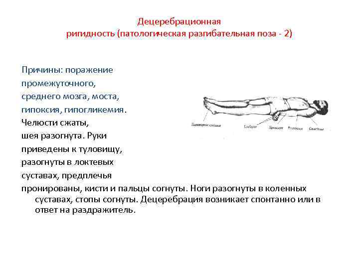 Децеребрационная ригидность (патологическая разгибательная поза - 2) Причины: поражение промежуточного, среднего мозга, моста, гипоксия,