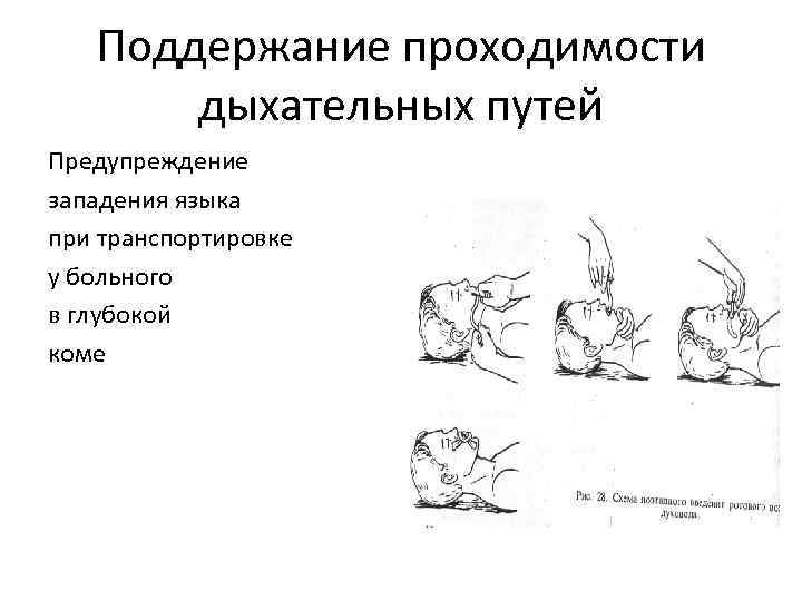 Поддержание проходимости дыхательных путей Предупреждение западения языка при транспортировке у больного в глубокой коме