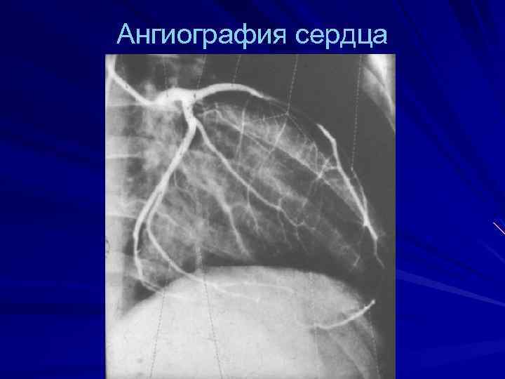Ангиография сердца 