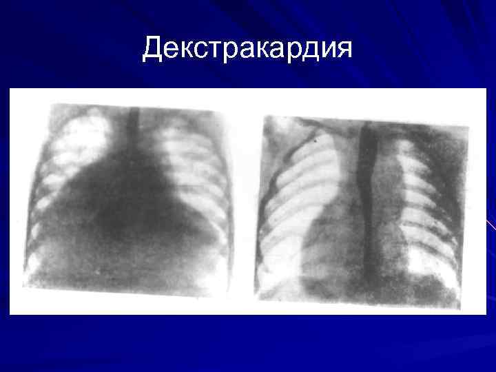 Декстракардия 