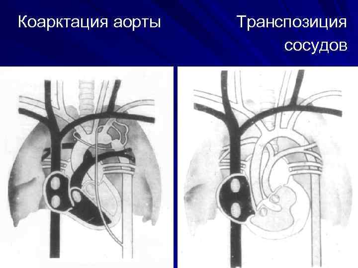 Коарктация аорты Транспозиция сосудов 
