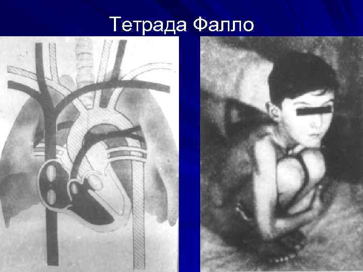 Тетрада Фалло 