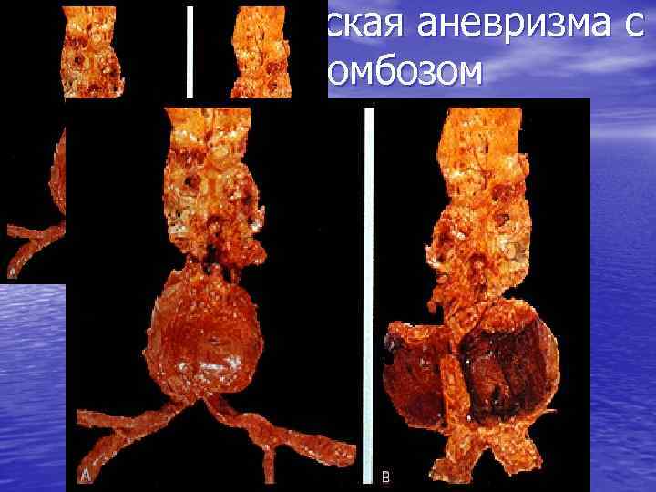 Атеросклеротическая аневризма с пристеночным тромбозом 