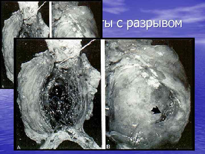 Аневризма аорты с разрывом 