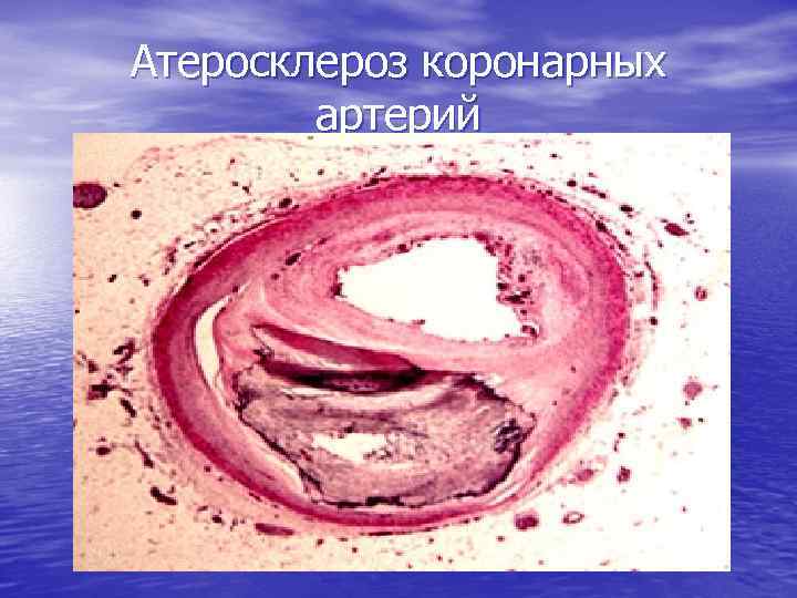 Атеросклероз коронарных артерий 