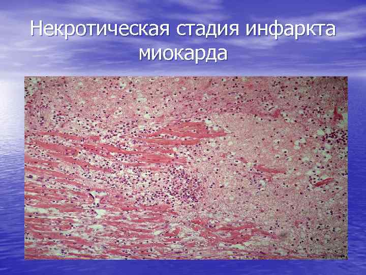 Некротическая стадия инфаркта миокарда 