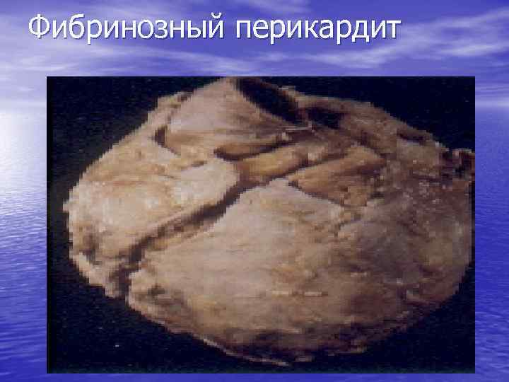Фибринозный перикардит 