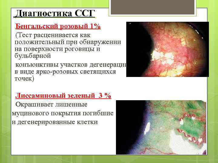  Диагностика ССГ Бенгальский розовый 1% (Тест расценивается как положительный при обнаружении на поверхности