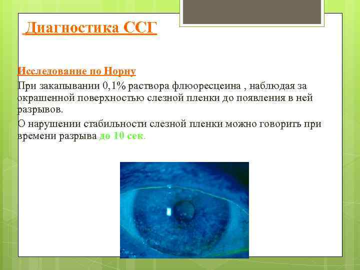  Диагностика ССГ Исследование по Норну При закапывании 0, 1% раствора флюоресцеина , наблюдая