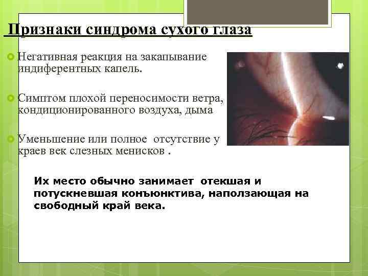  Признаки синдрома сухого глаза Негативная реакция на закапывание индиферентных капель. Симптом плохой переносимости